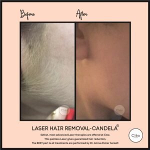 Hair Reduction