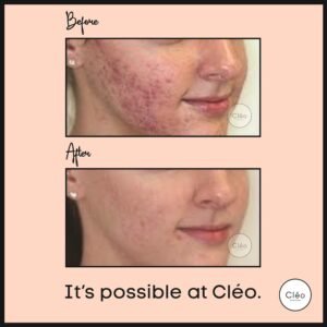 Skin Diseases
