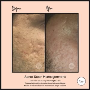 Acne Scar Reduction