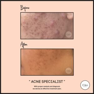 Skin Diseases