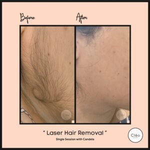 Hair Reduction