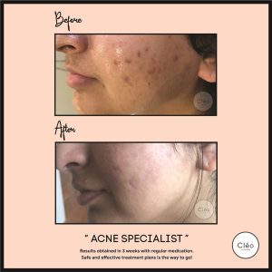 acne specialist