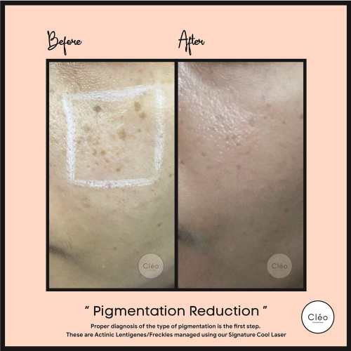 pigmentation reduction