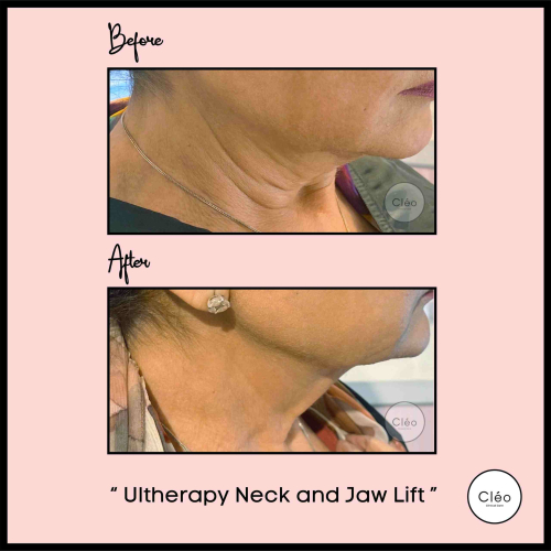 ultherapy neck and jaw