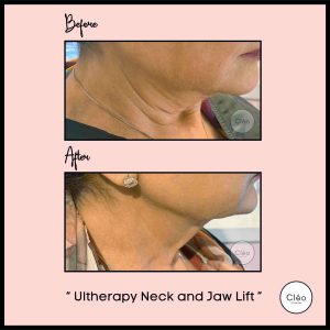 ultherapy neck and jaw