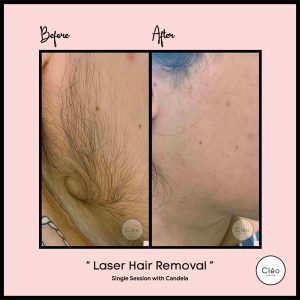 laser hair removal