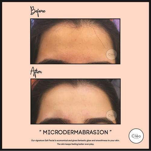 microdermabrasion