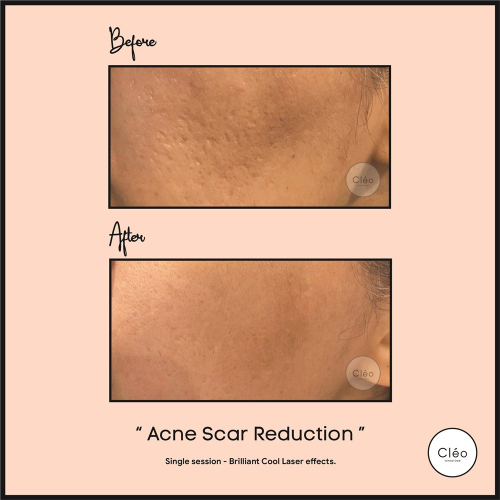 acne scar reduction