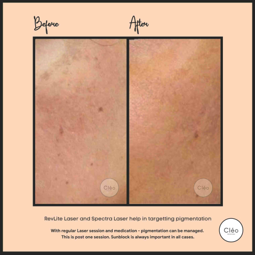 laser pigmentation