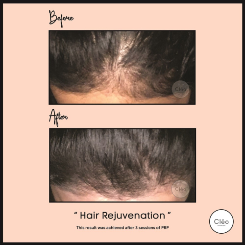 Hair Rejuvenation