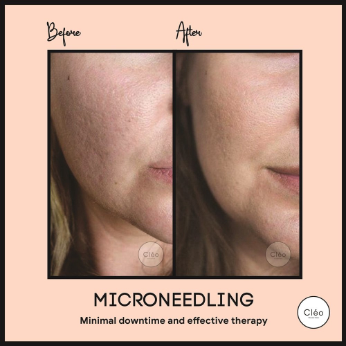 microneedling
