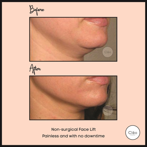 NON-SURGICAL FACE LIFT