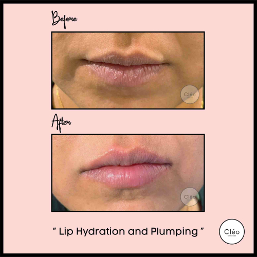 lip hydration and plumping