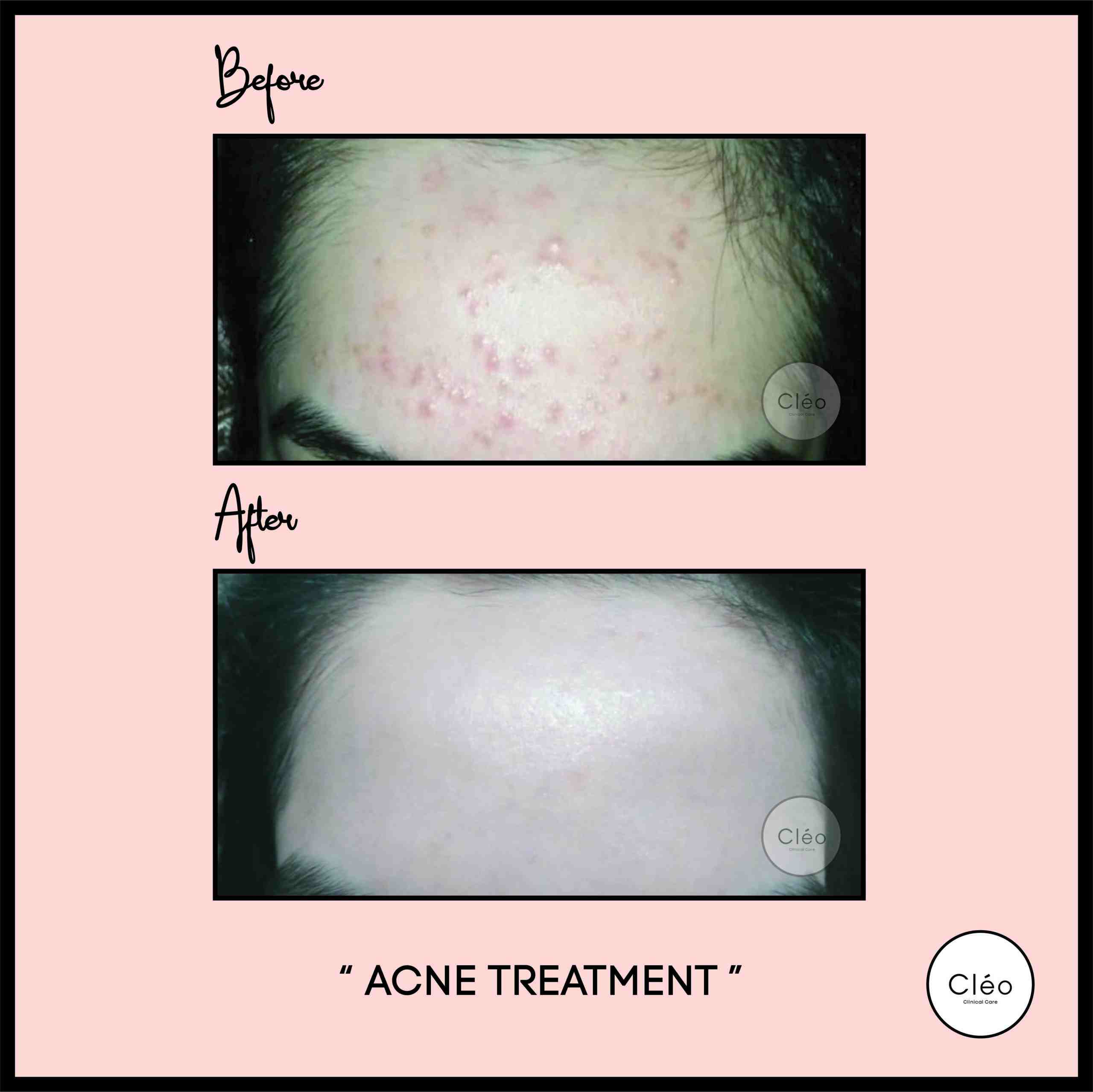 acne treatment