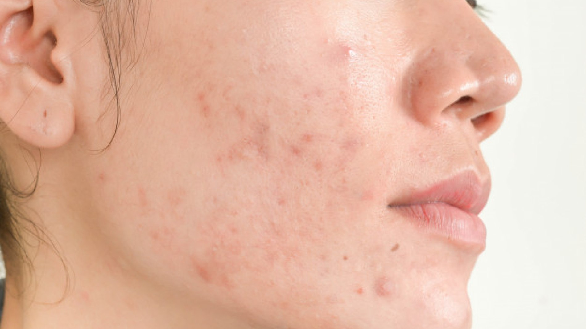 Skin Diseases