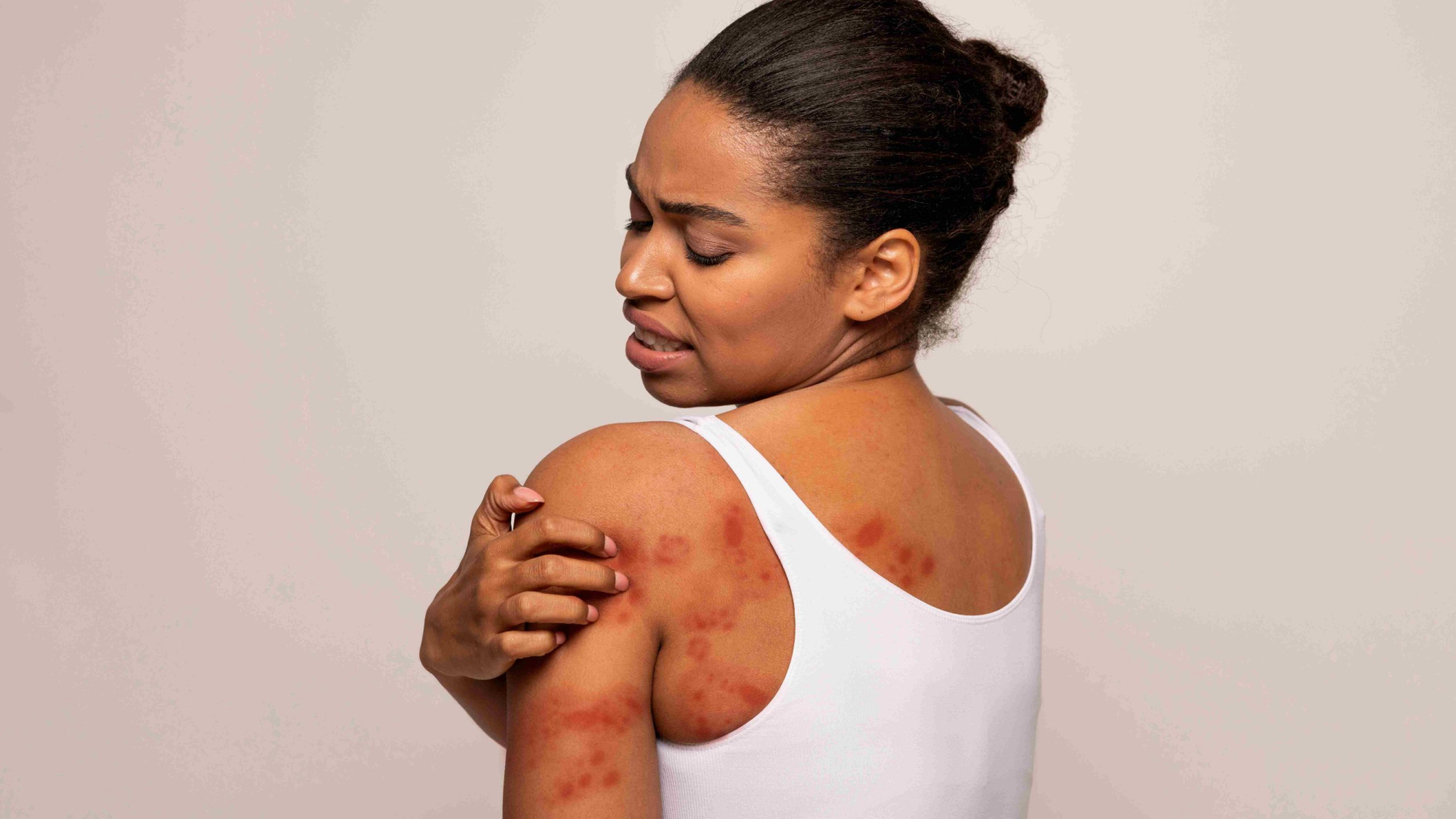 black-woman-scratching-red-spots-on-her-skin-2025-03-18-16-59-46-utc_11zon