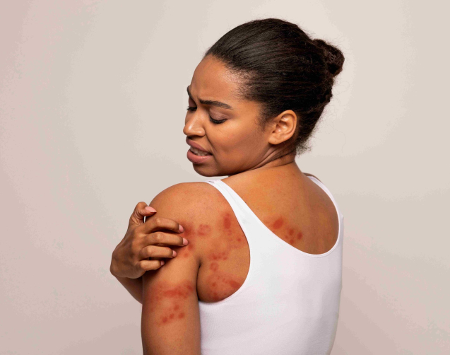 black-woman-scratching-red-spots-on-her-skin-2025-03-18-16-59-46-utc_11zon