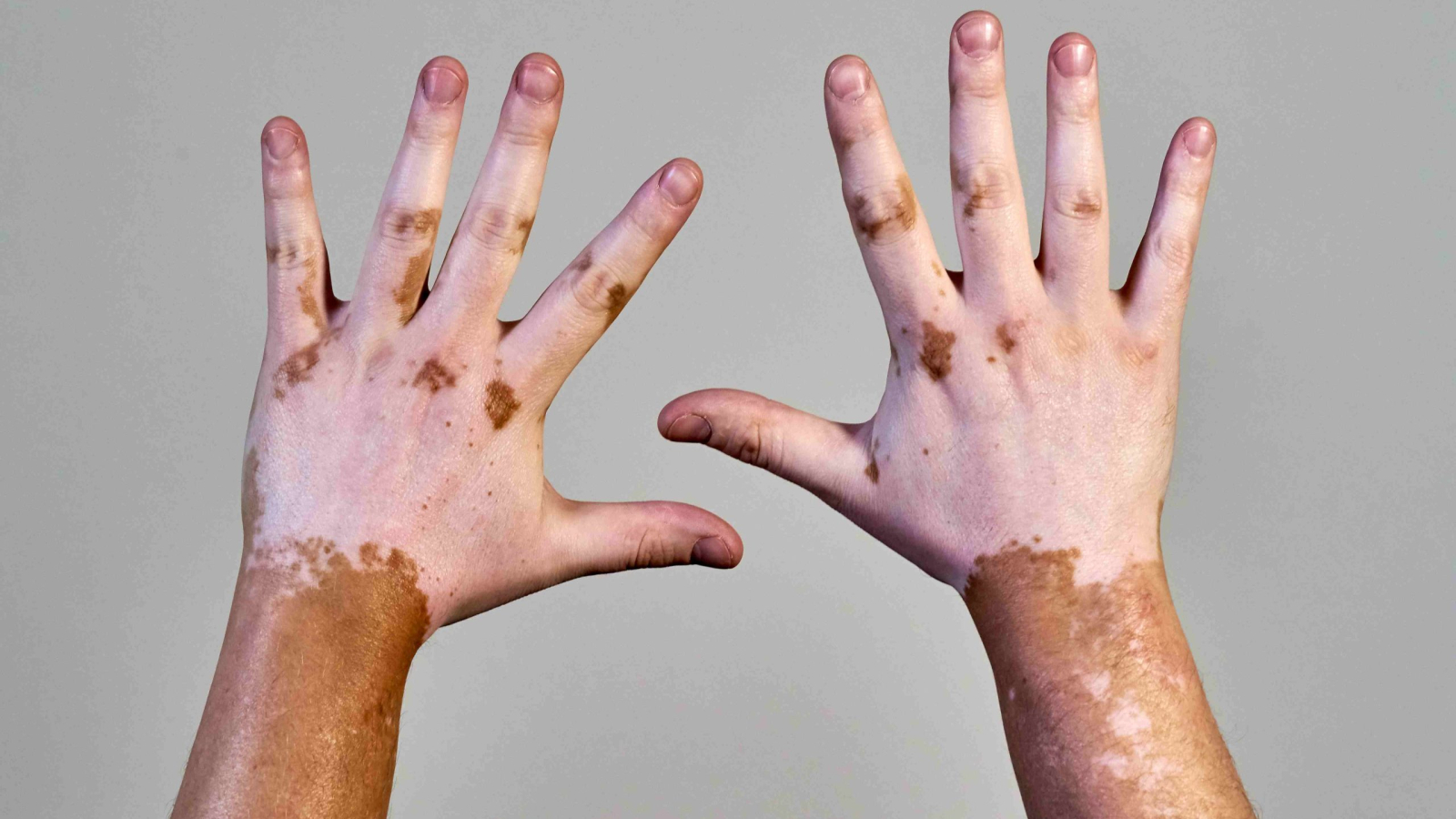 vitiligo-skin-disease-on-male-hands-2025-02-09-20-13-28-utc_11zon
