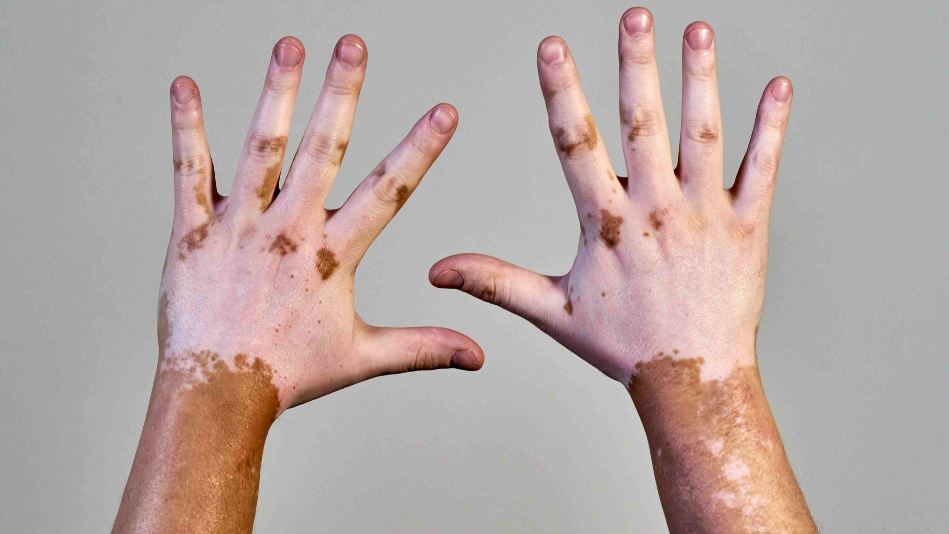 vitiligo-skin-disease-on-male-hands-2025-02-09-20-13-28-utc_11zon