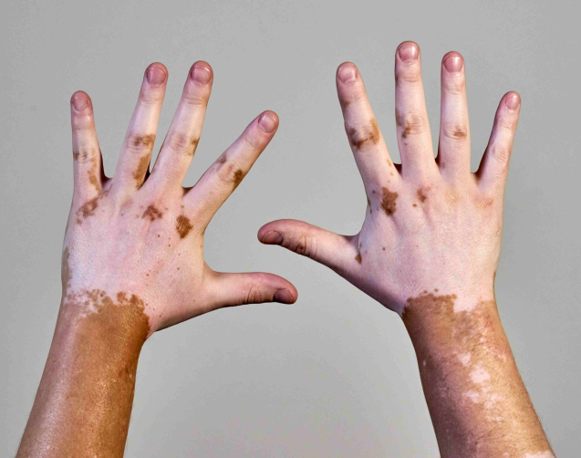 vitiligo-skin-disease-on-male-hands-2025-02-09-20-13-28-utc_11zon