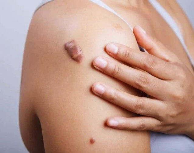 Keloid Treatment