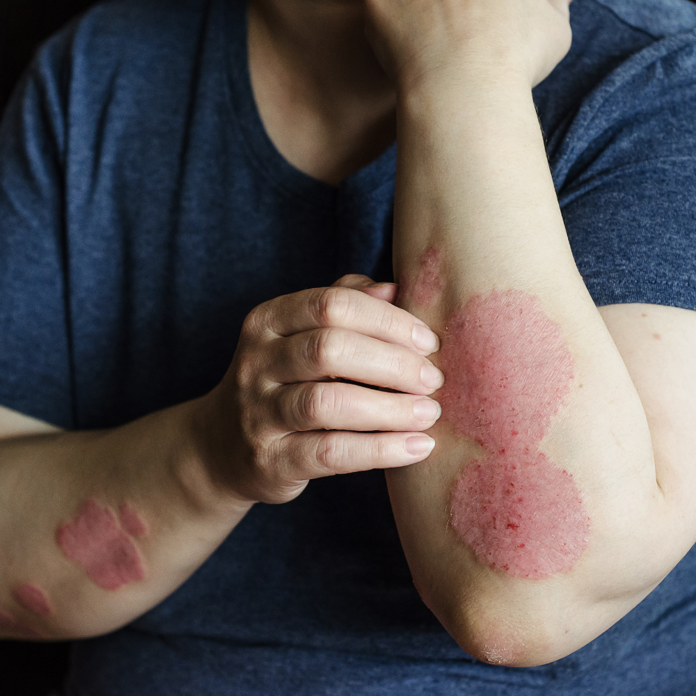 Eczema