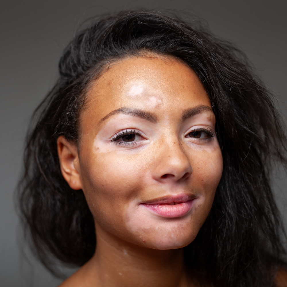 Vitiligo