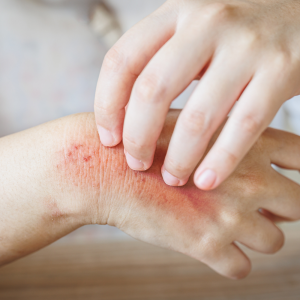 Fungal Skin Infections