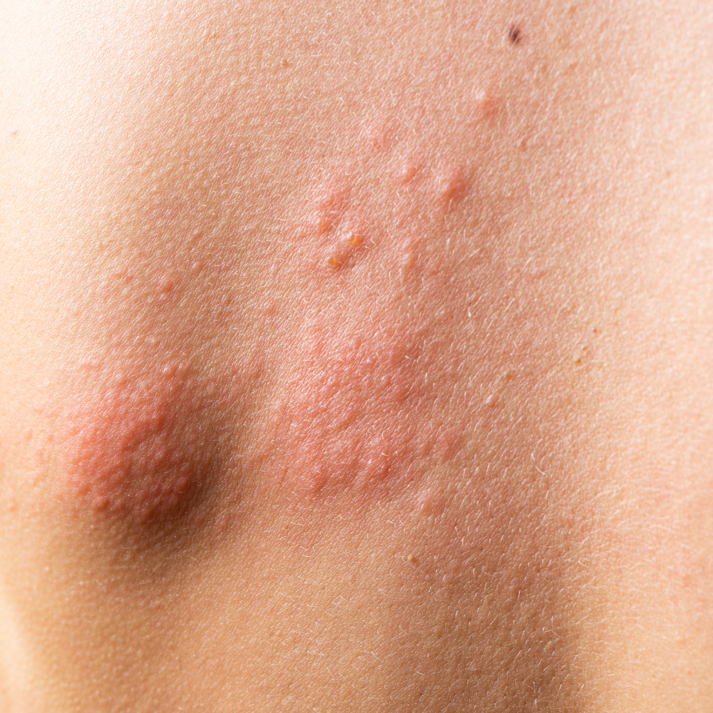 Bacterial Skin Infections
