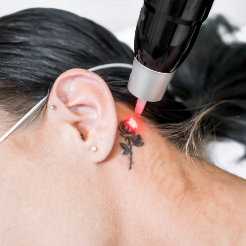 Tattoo Removal