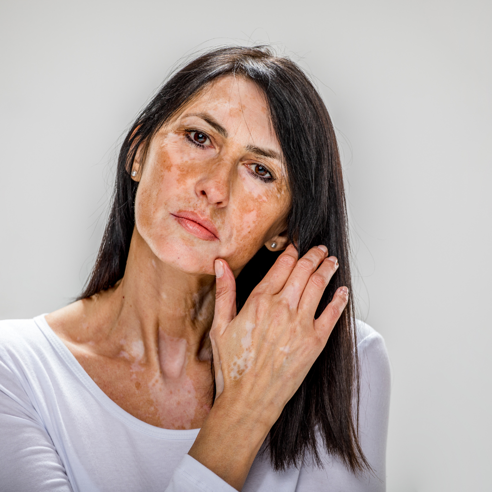 Vitiligo