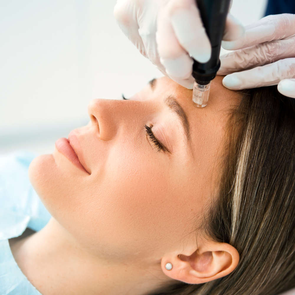 Hair Rejuvenation Micro-Needling