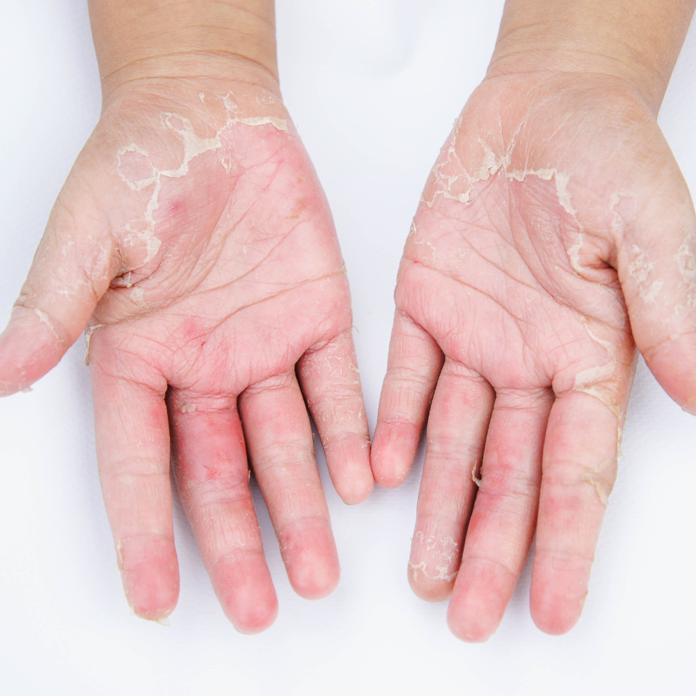 Fungal Skin Infections