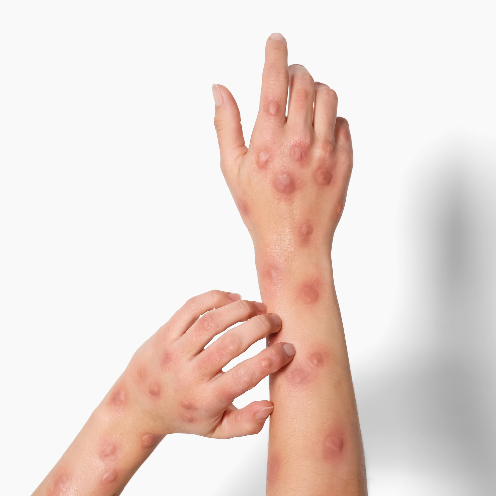 Bacterial Skin Infections