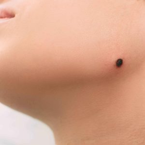 Mole Removal